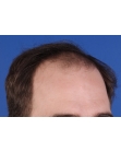 Before Hair Transplant&nbsp;Front